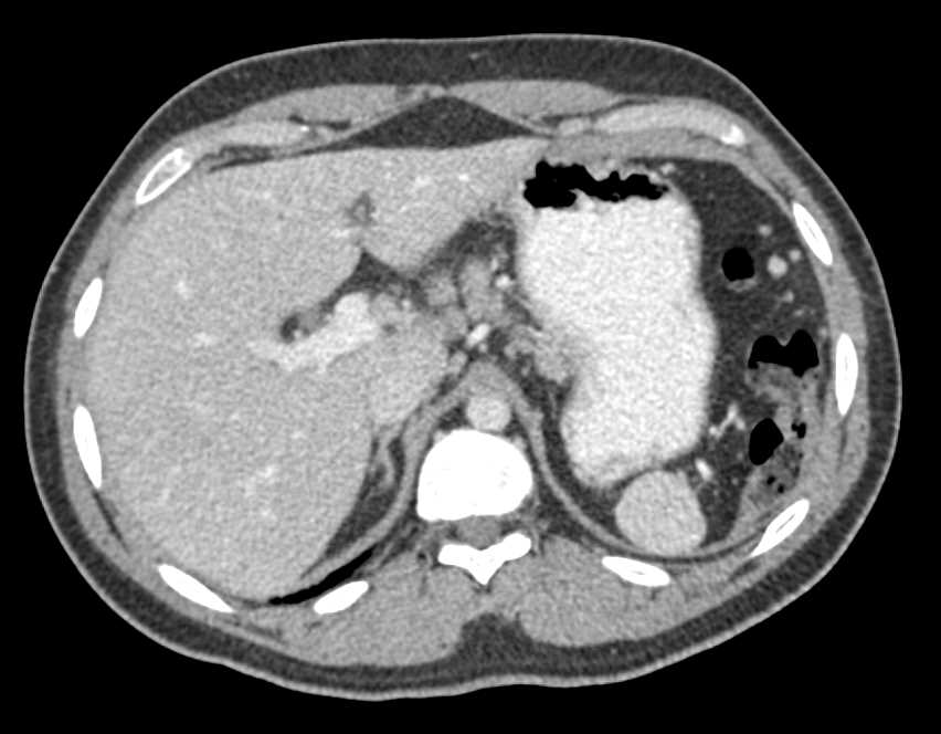 Multiple Accessory Spleens - CTisus CT Scan