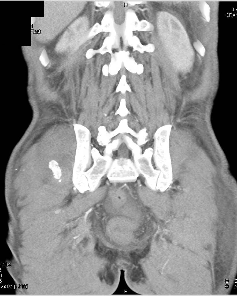 Pseudo-aneurysm Right Gluteus Muscle in Patient wit Prior Biopsy of the Iliac Crest in Patient with Lymphoma and Splenic Infiltration - CTisus CT Scan