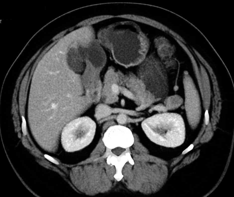 Low Density Lesion in an Accessory Spleen - CTisus CT Scan