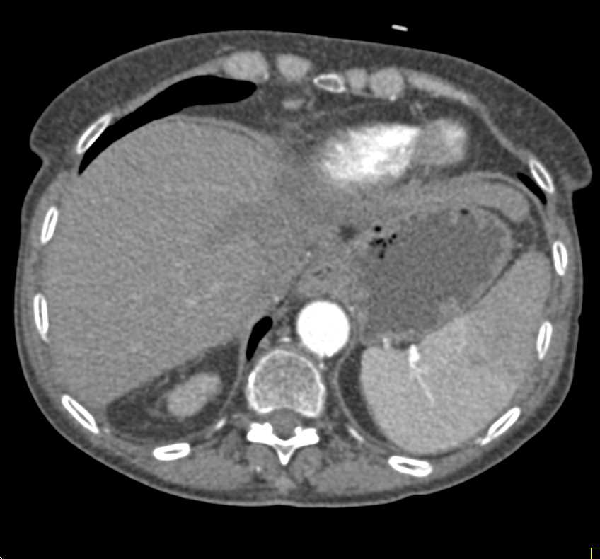 Splenic Infarction with Splenic Artery Aneurysms and a Vasculitis - CTisus CT Scan