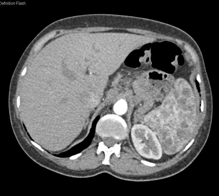 Sarcoidosis of the Spleen in a Patient with Cirrhosis and Portal Hypertension - CTisus CT Scan