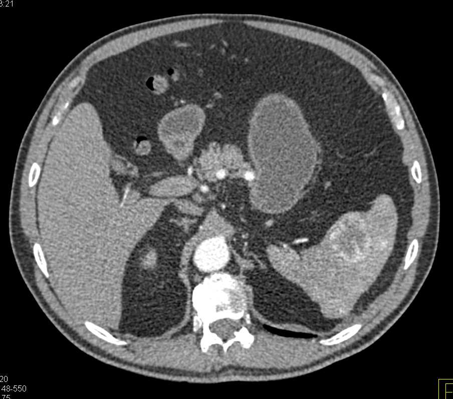 Splenic Hemangioma and Multiple Pancreatic Intraductal Papillary Mucinous Neoplasms (IPMNs) - CTisus CT Scan