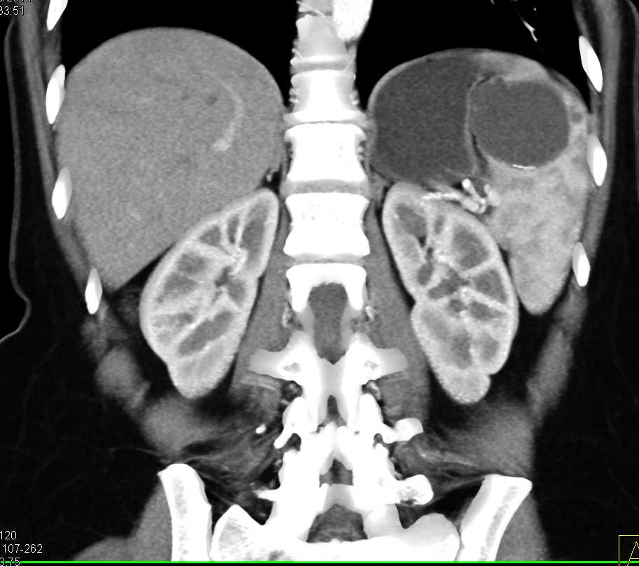 Splenic Cyst with Rim Calcification - CTisus CT Scan