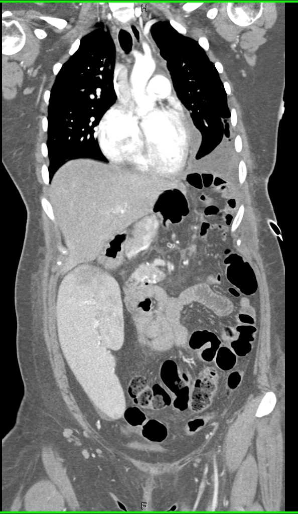 Spleen is Rotated into the Right Lower Quadrant - CTisus CT Scan