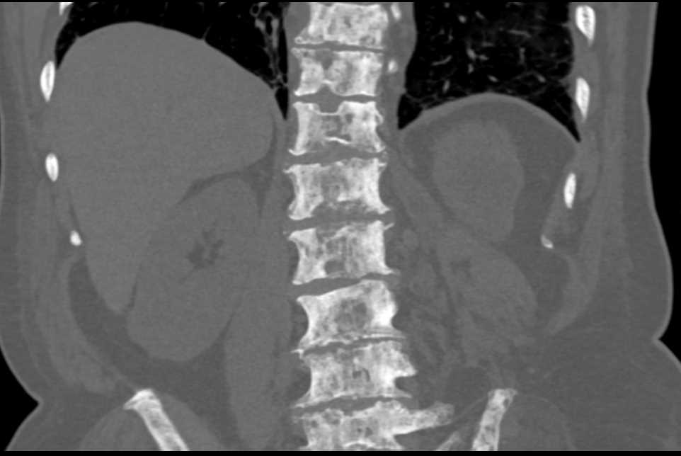 Sickle Cell Disease in Spine - CTisus CT Scan