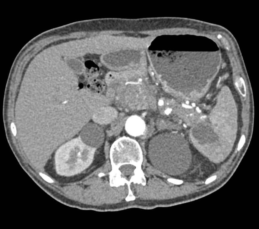 Chronic Pancreatitis with Pseudocyst Extends into the Spleen - CTisus CT Scan