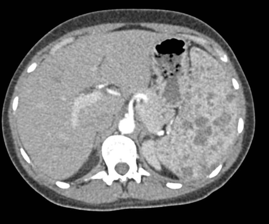 Klippel Trenaunay Weber (KTW) with Splenic Hemangiomas and Soft Tissue Hemangioma - CTisus CT Scan