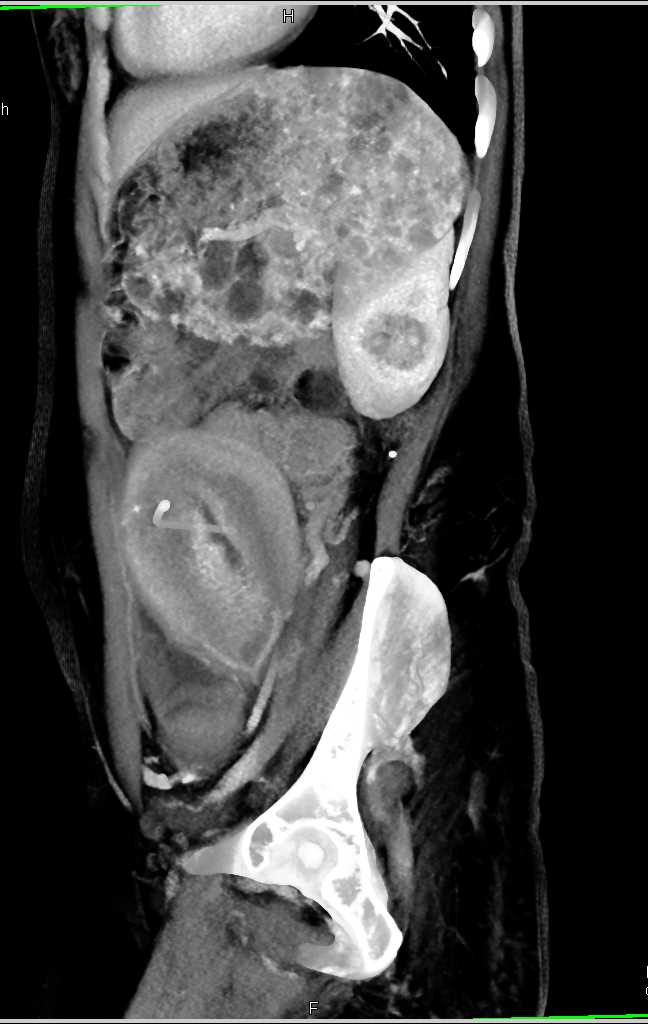 Klippel Trenaunay Weber (KTW) with Splenic Hemangiomas and Soft Tissue Hemangioma, Postpartum - CTisus CT Scan