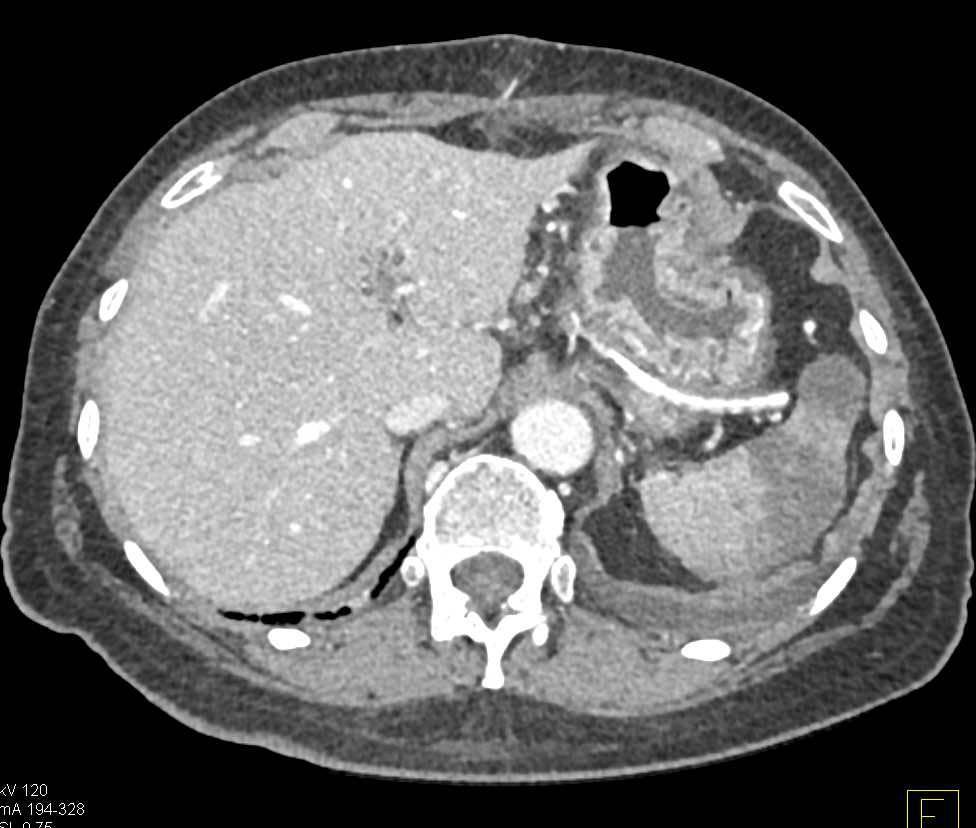 Splenic Infarct Following Whipple Procedure - CTisus CT Scan