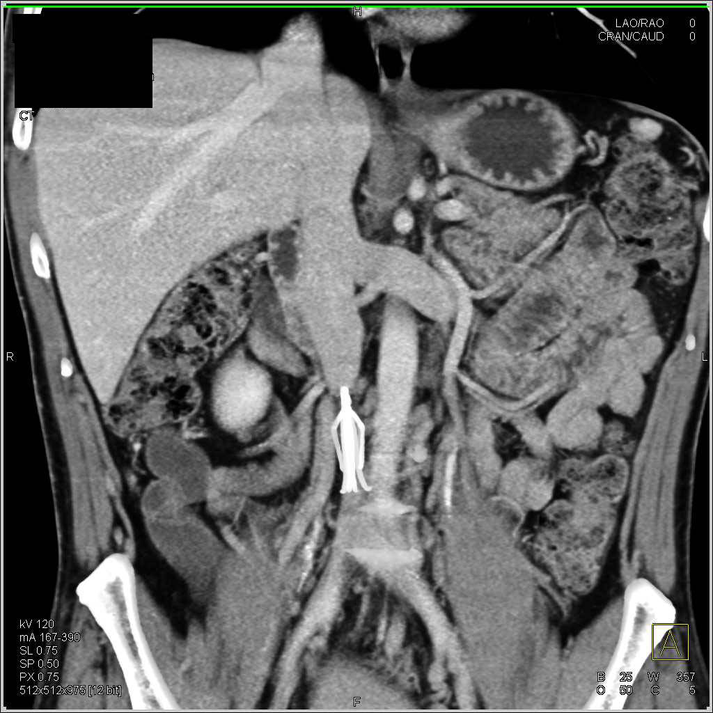 Multiple Splenules - CTisus CT Scan