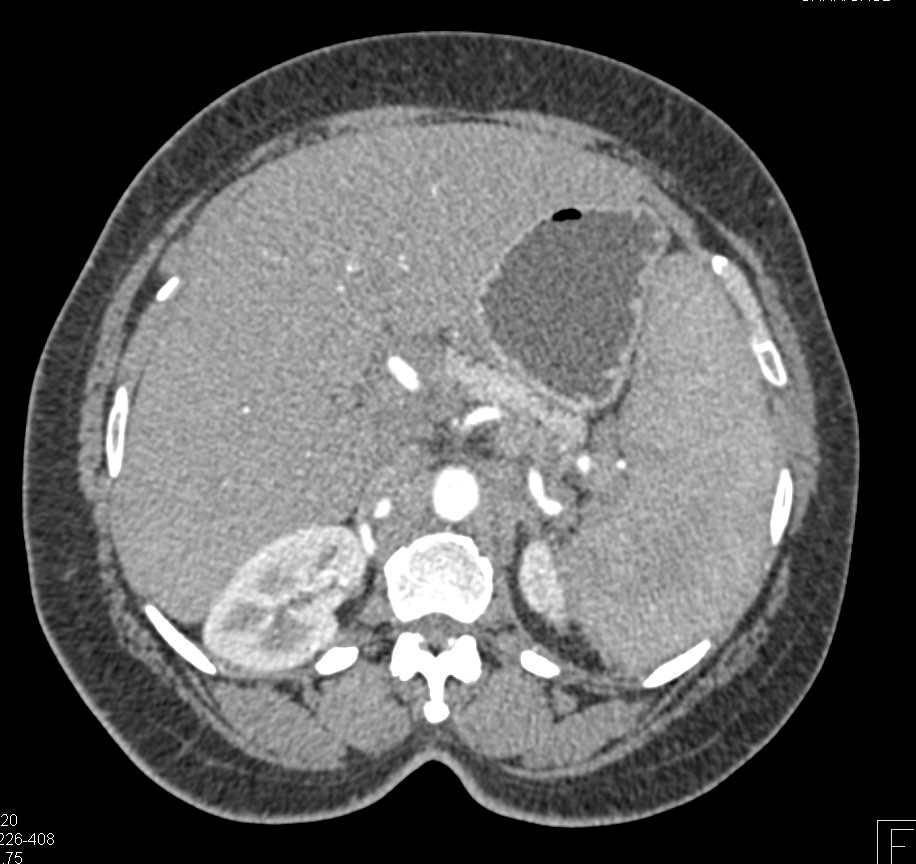 Splenomegaly and Splenic Lesions in Sarcoidosis - CTisus CT Scan