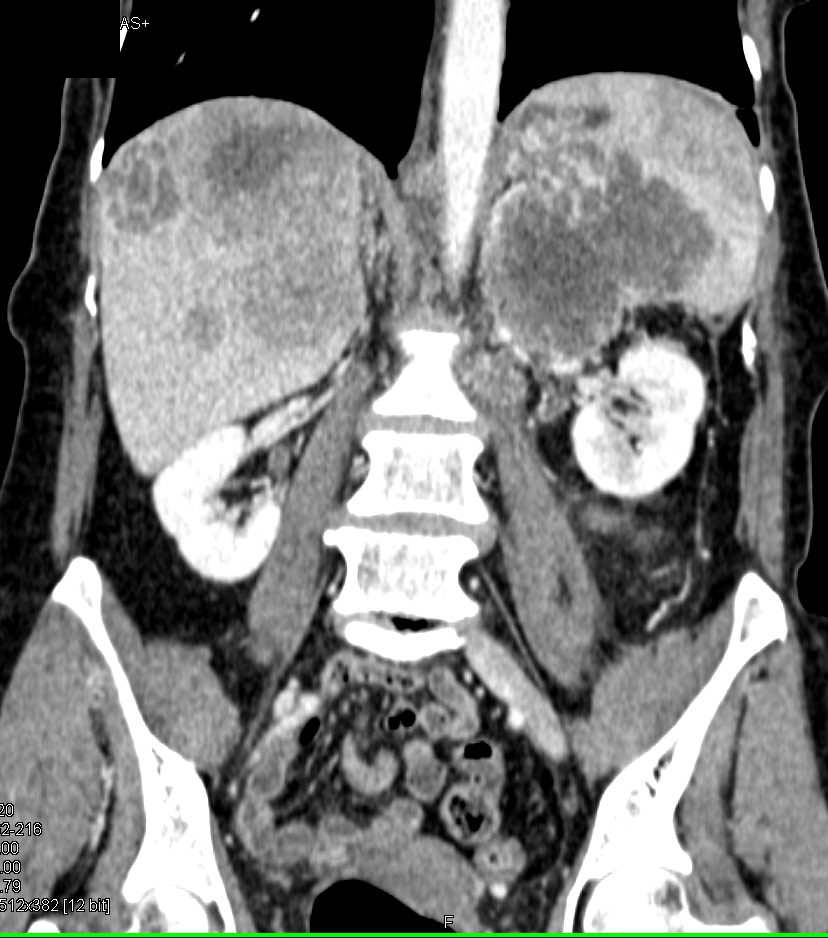 Metastatic Melanoma Involves the Liver and Spleen - CTisus CT Scan