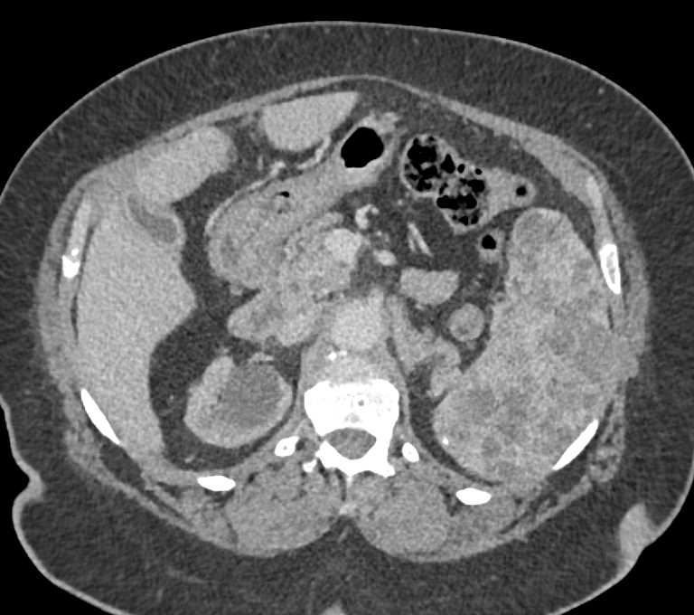 Multiple Splenic Hemangiomas - CTisus CT Scan