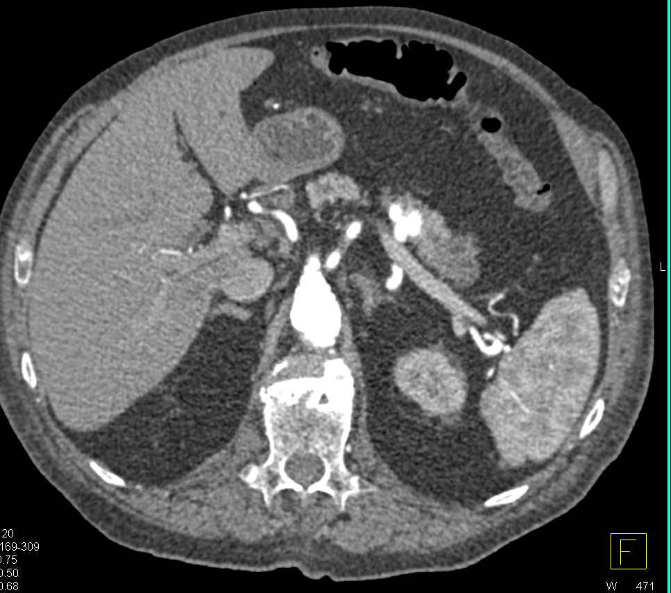 Splenic Artery Aneurysm - CTisus CT Scan