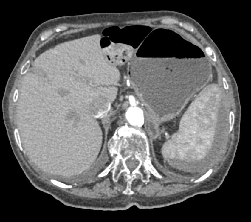 Subcapsular Hematoma Spleen - CTisus CT Scan