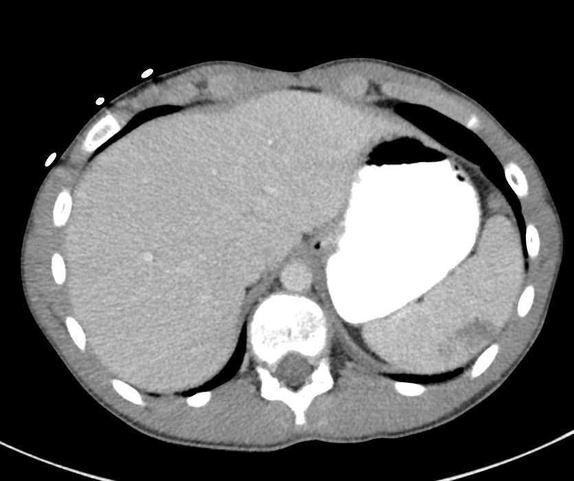 Pneumonia and Splenic Infarction - CTisus CT Scan