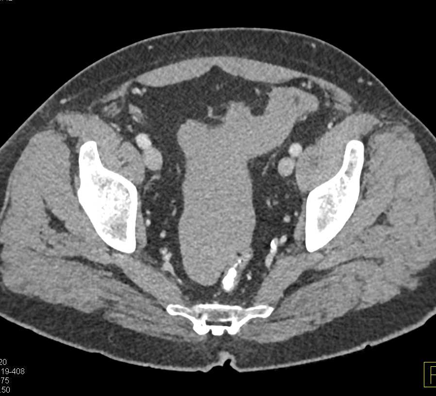 Spontaneous Splenic Bleed with Hemoperitoneum - CTisus CT Scan