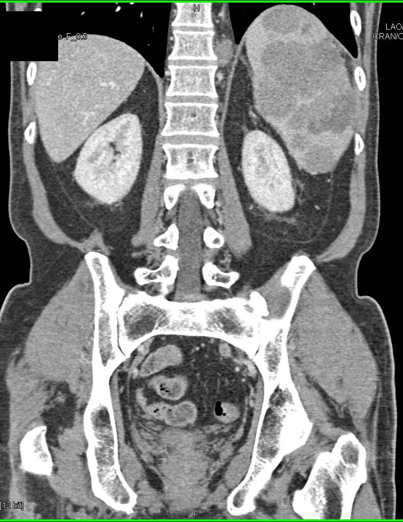 Primary Lymphoma of the Spleen - CTisus CT Scan