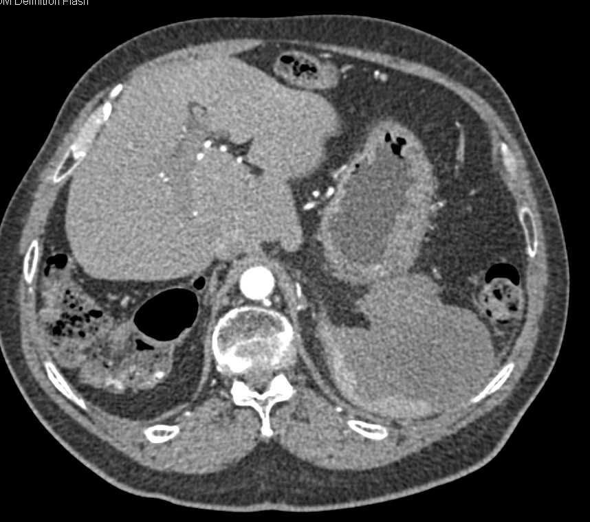 Large Splenic Infarct - CTisus CT Scan