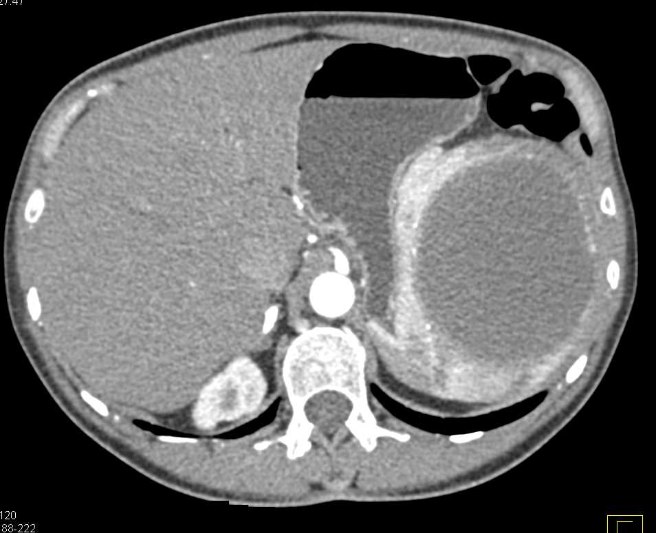 True Splenic Cyst - CTisus CT Scan