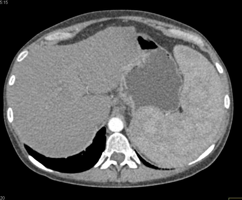Portal Hypertension with Large Spleen - CTisus CT Scan