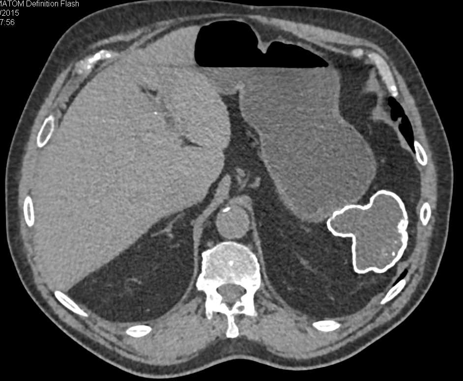 Auto infarcted and Calcified Spleen - CTisus CT Scan
