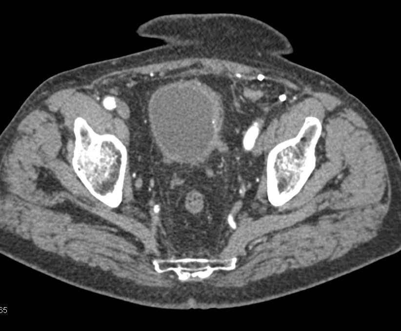 Auto infarcted and Calcified Spleen - CTisus CT Scan