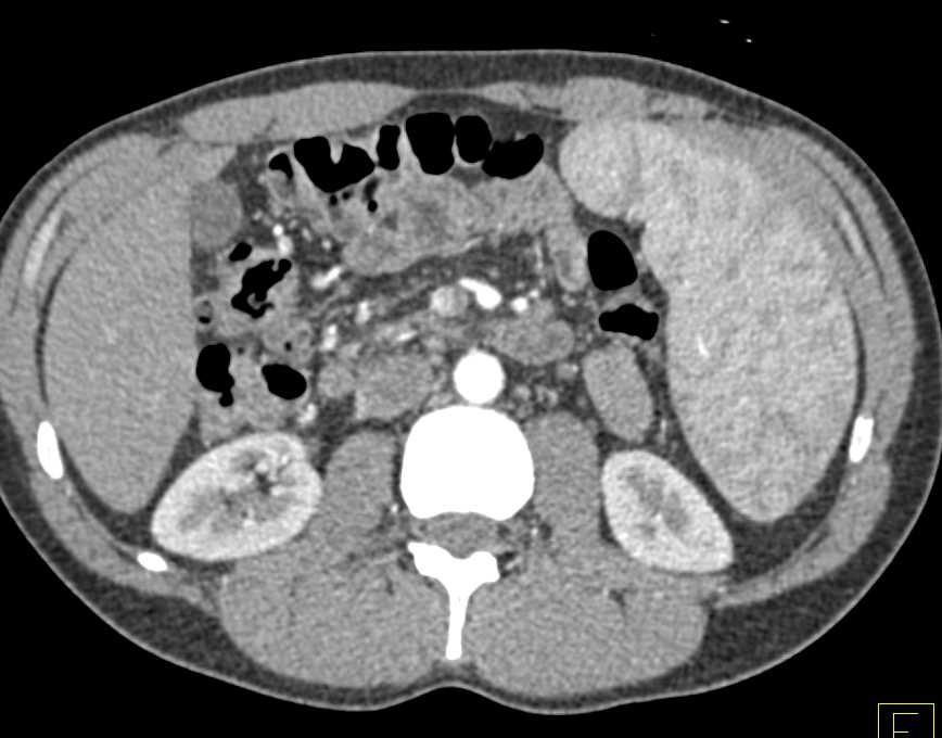 Splenomegaly with Thickened Small Bowel due to Sprue - CTisus CT Scan