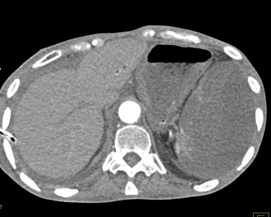 Global Infarction of the Spleen - CTisus CT Scan