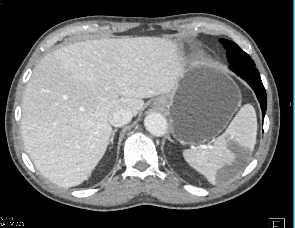 Multiple Splenic Infarcts - CTisus CT Scan