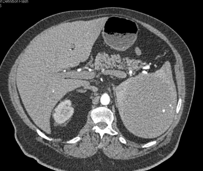 Splenic Hamartoma - CTisus CT Scan