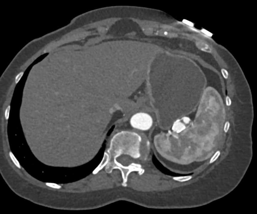 Splenic Artery Aneurysm - CTisus CT Scan