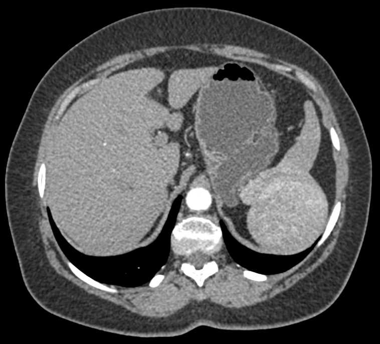 Splenic Hamartoma - CTisus CT Scan