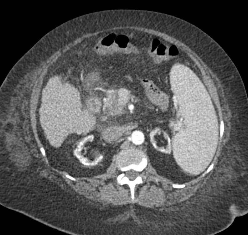 Cirrhosis with Splenomegaly - CTisus CT Scan