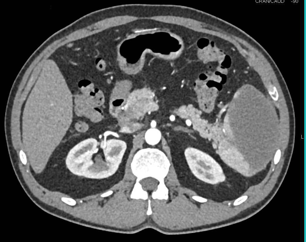 Subcapsular Hematoma in the Spleen - CTisus CT Scan