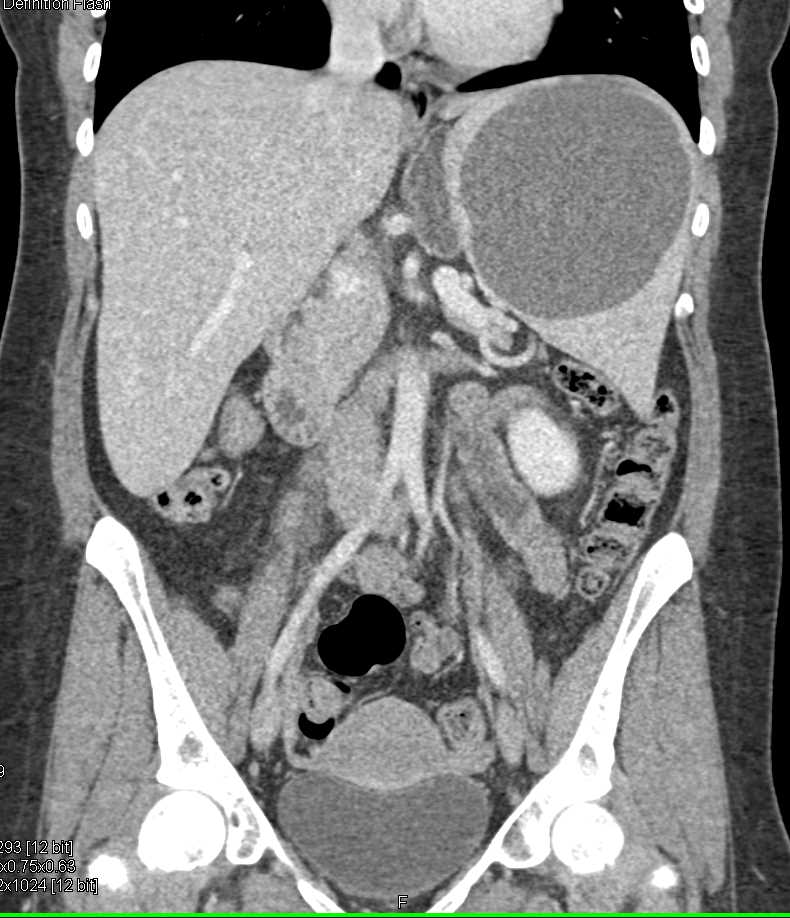 Splenic Cyst - CTisus CT Scan