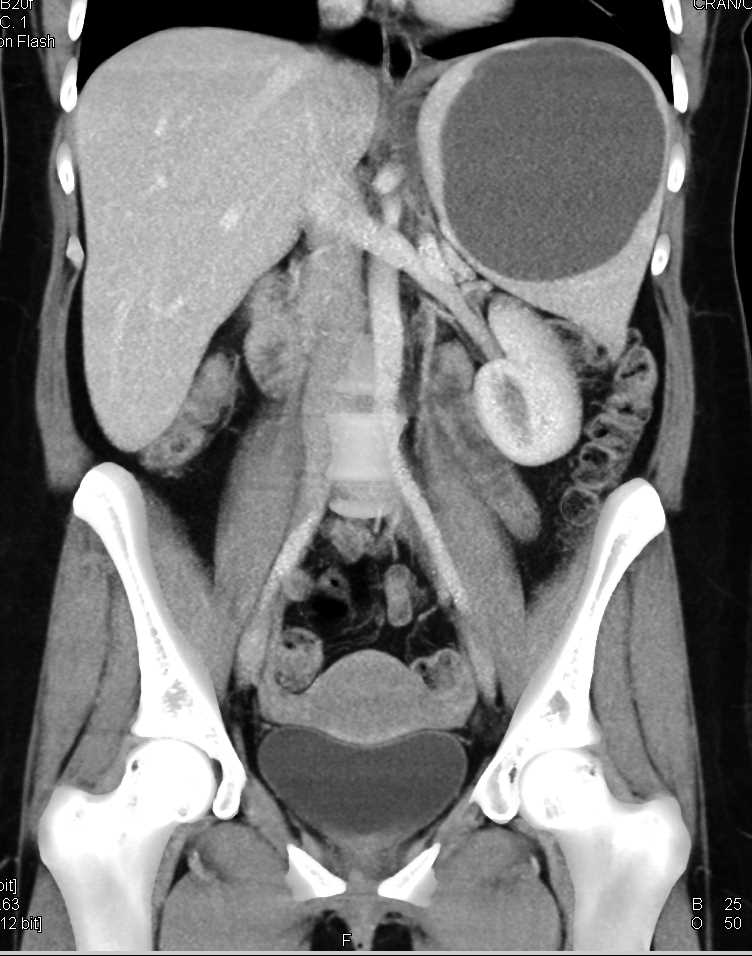 Splenic Cyst - CTisus CT Scan