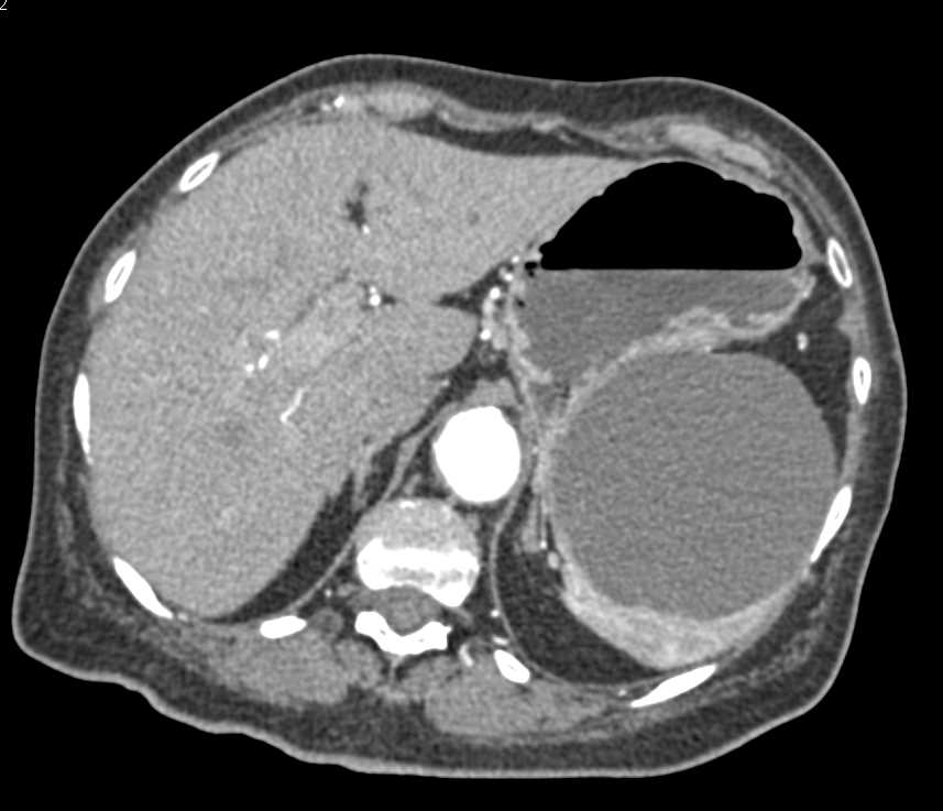 Splenic Cyst and Pancreas Intraductal Papillary Mucinous Neoplasm (IPMN) - CTisus CT Scan