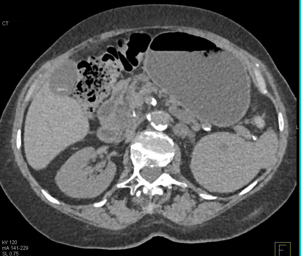 Splenic Hamartoma - CTisus CT Scan