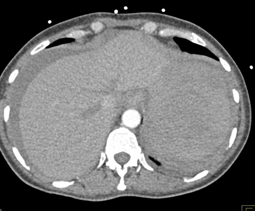 Splenic Laceration with Hemoperitoneum - CTisus CT Scan