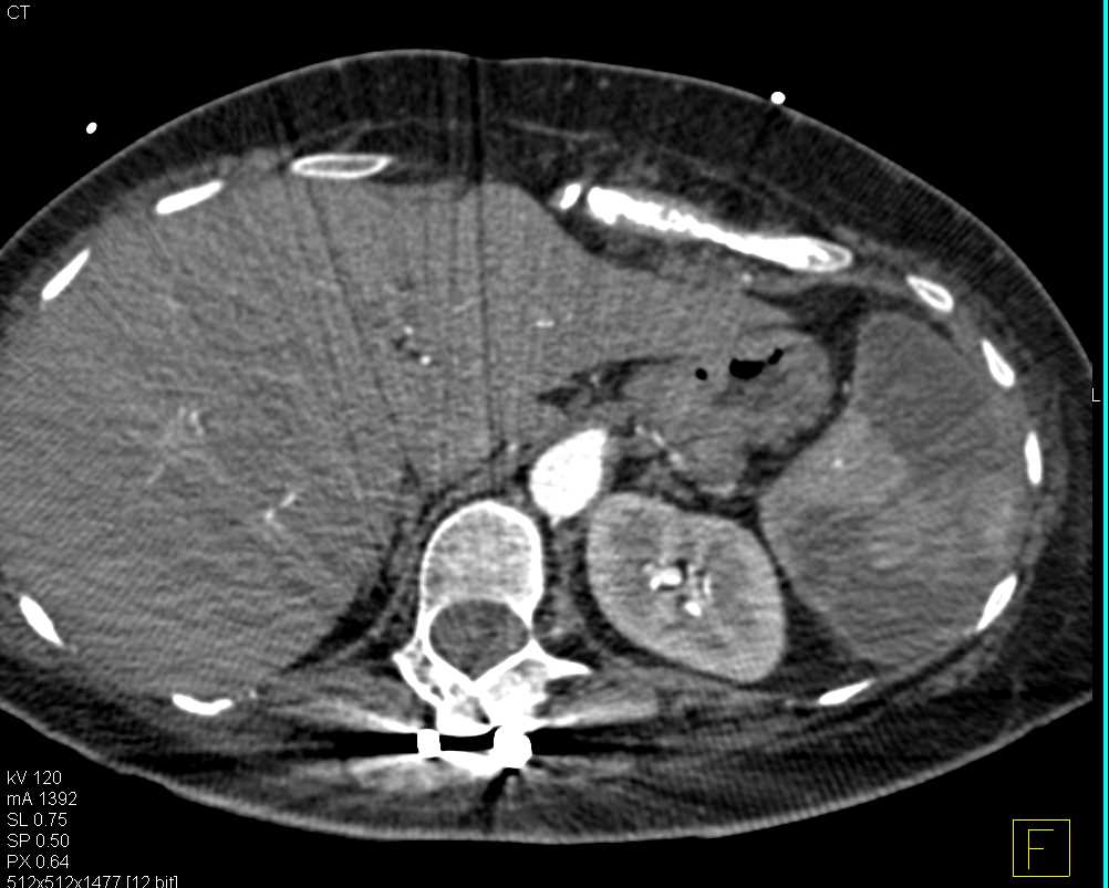 Splenic Infarcts - CTisus CT Scan