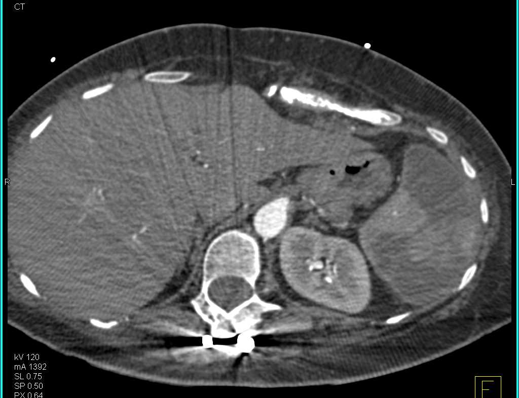 Splenic Infarcts - CTisus CT Scan