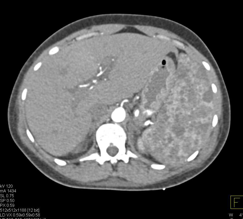 Multiple Splenic Hemangiomas - CTisus CT Scan