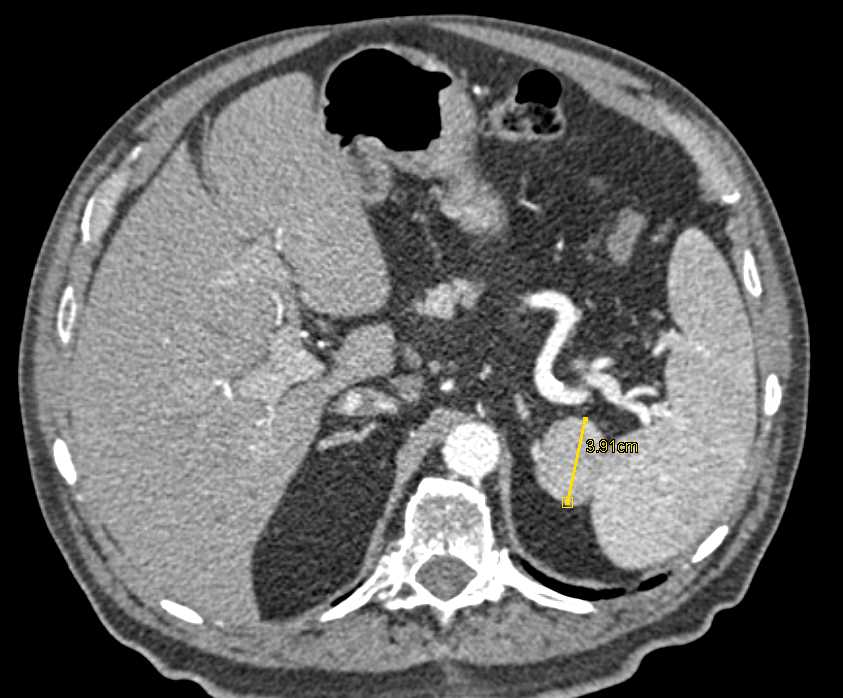 Splenule - CTisus CT Scan