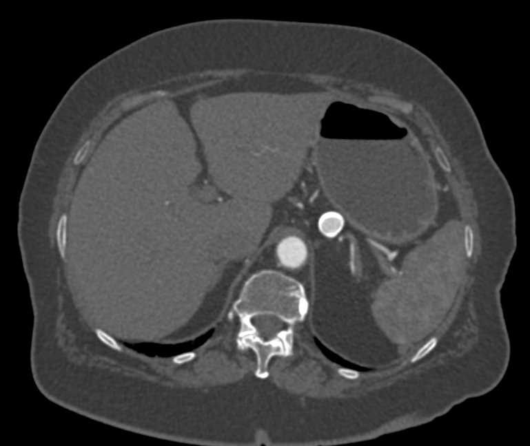 Splenic Artery Aneurysm - CTisus CT Scan