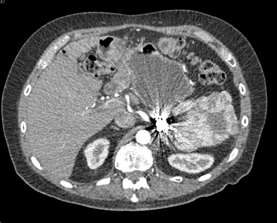 Splenic Infarction s/p Coiling - CTisus CT Scan