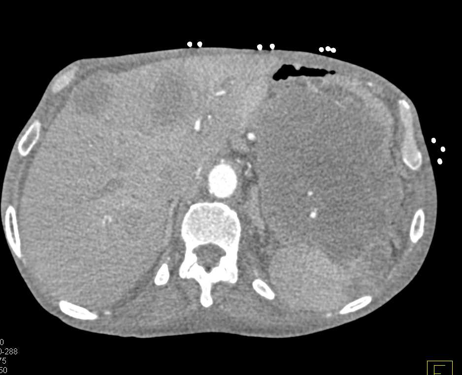 Lymphoma Involves the Spleen - CTisus CT Scan