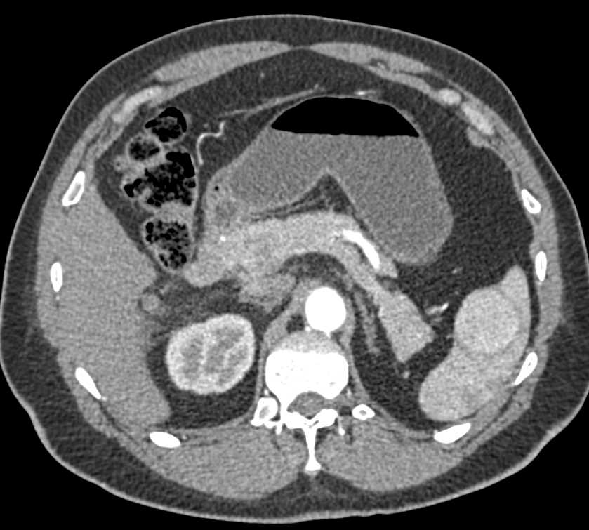 Splenic Hamartoma - CTisus CT Scan