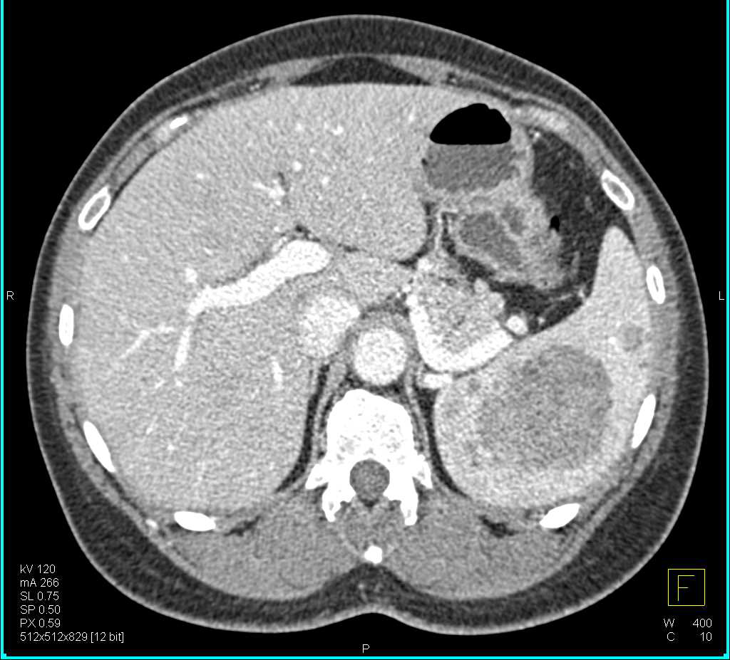 Littoral Cell Angioma - CTisus CT Scan