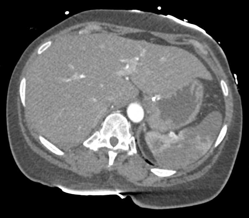 Splenic Infarcts and Renal Infarcts - CTisus CT Scan